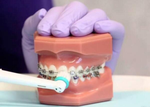 卸了牙套能用電動牙刷嗎？答案就在這篇文章